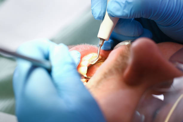 Best Emergency Dentist for Lost Fillings or Crowns in Zion, PA